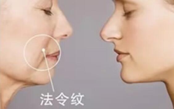 改善法令纹美容仪：低价实现高效抚平效果，让你焕发青春活力！