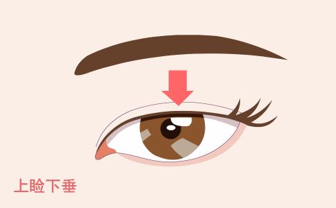 激光祛斑 神奇斑点“橡皮擦”