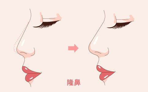 激光祛斑术后如何护理