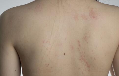 女性脸上长斑究竟是什么原因