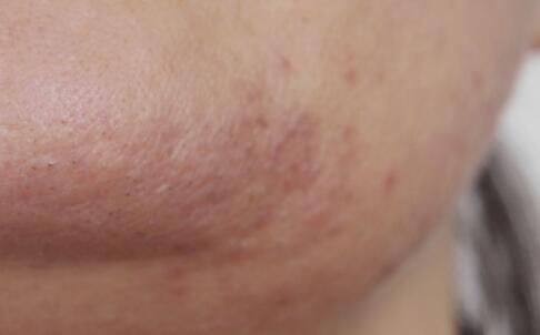 怎样祛痘最快 帮你打造无痕美肌