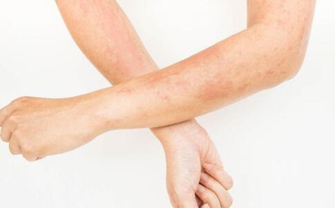 最有效的祛痘方法帮你打造完美肌肤