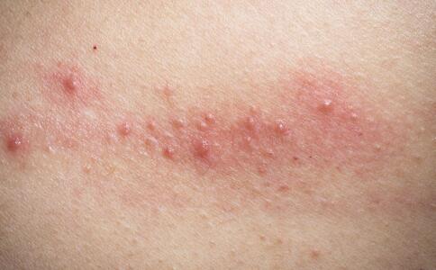 寻找秋季最佳祛痘方法