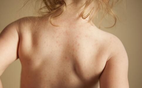 避孕药可做祛痘用？