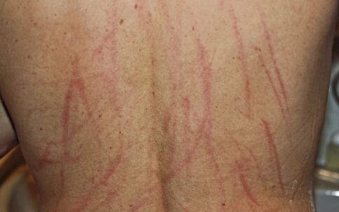 夏日祛痘5大的注意事项