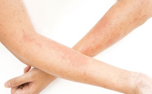 5大祛痘禁忌长痘痘决不能做