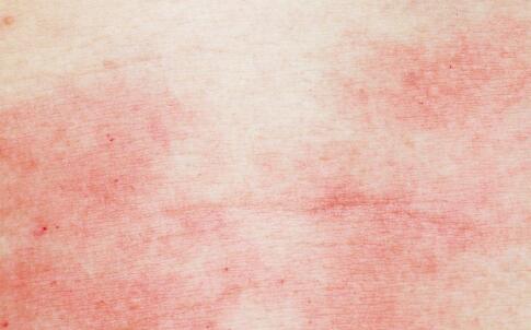 最佳的祛痘产品排行榜