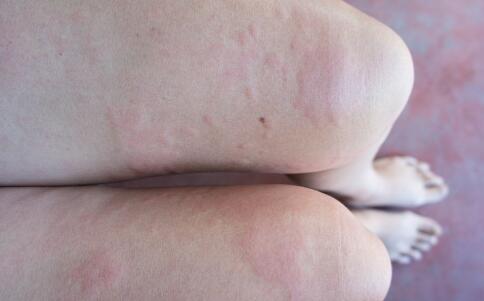 最有效的祛痘方法帮你新年战痘