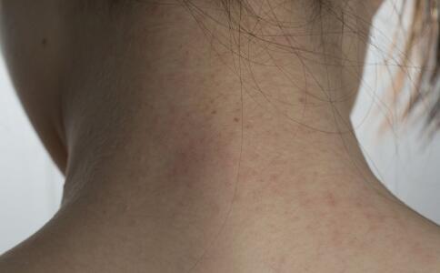 祛痘最快的方法 “痘”花妹不可不看四个祛痘方法