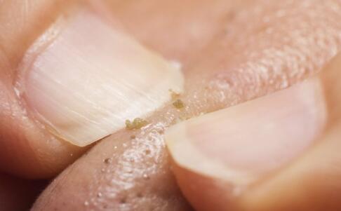 怎么祛痘快 三个祛痘秘籍解忧愁