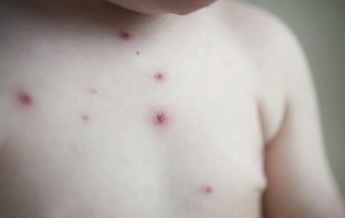 夏季祛痘最有效的9个方法