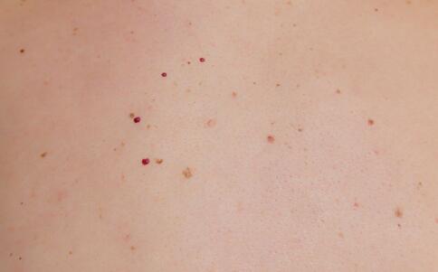 逗MM最爱的8款祛痘产品