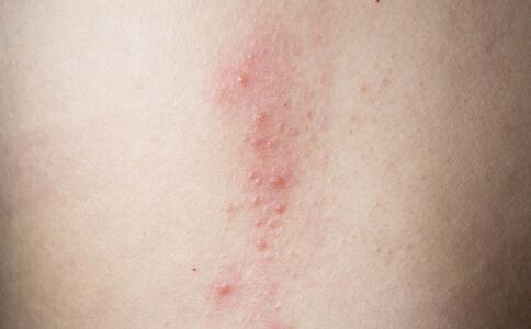 范冰冰祛痘的绝招