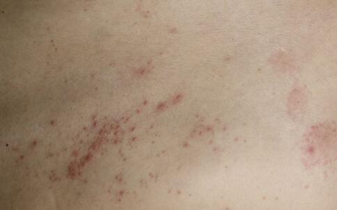 祛痘产品哪个好 各方人士共同推举祛痘产品中的明星