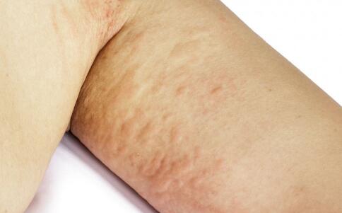 祛痘比较好的产品 让痘痘不再成为你的苦恼