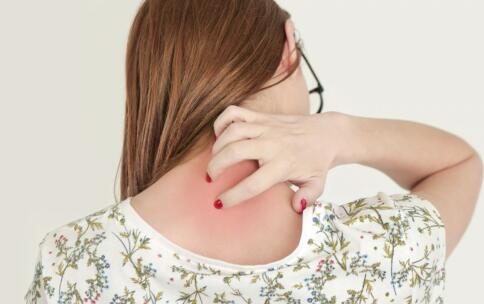 祛痘特有效的4锦囊