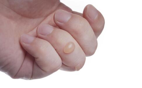 夏季祛痘应避开的5大误区