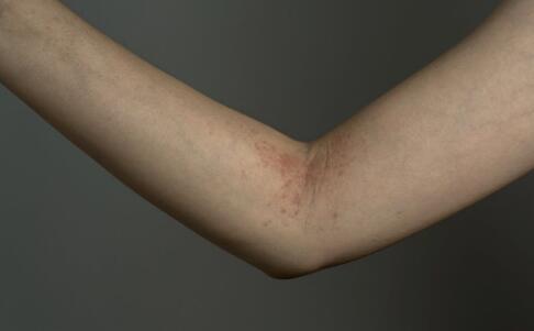 后背长痘痘怎么办 正确的祛痘的步骤