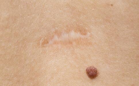 祛痘吃什么 喝出健康美肌的12款祛痘食品