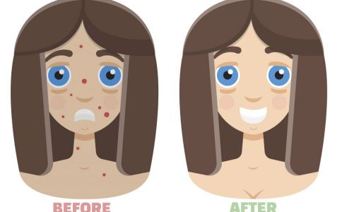 去痘印小妙招 细数生活中的祛痘秘诀