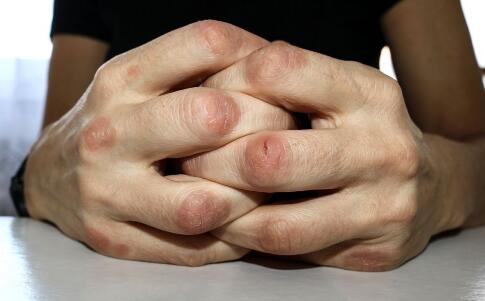 中药祛痘配方再不知道，就追悔莫及