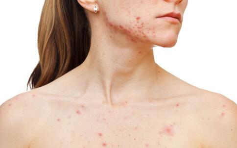 中药祛痘配方有哪些?你不知道的还有很多