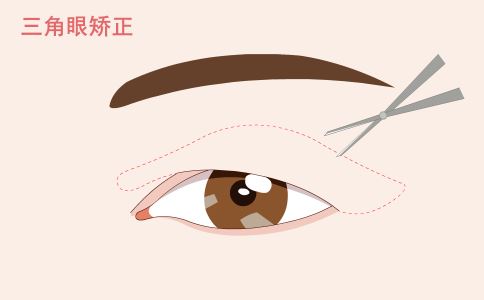 做面部拉皮除皱时应注意什么?