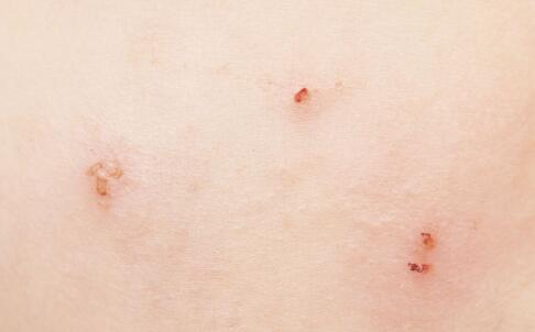 哪些因素会增长皱纹